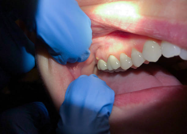 Best Dentist for Tooth Abscess  in Cartervle, IL